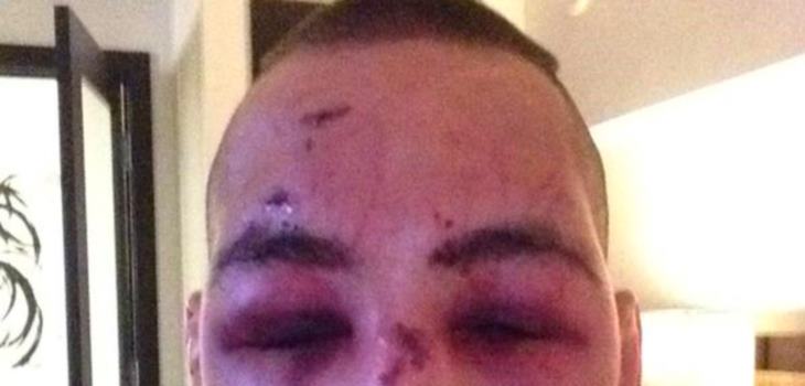 Rory MacDonald broken nose ufc 189